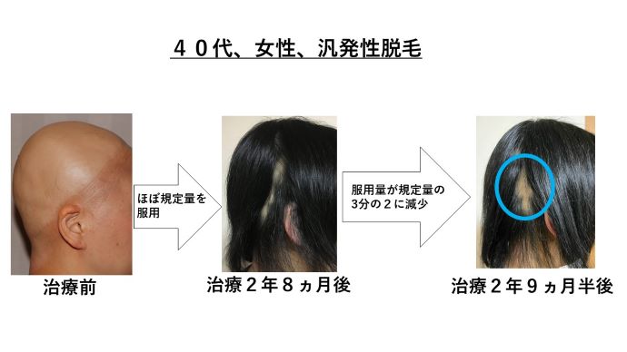 円形脱毛症　病院